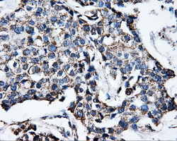 Immunohistochemical staining of paraffin-embedded Adenocarcinoma of breast tissue using anti-ATP5B mouse monoclonal antibody