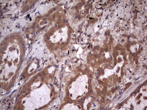 Immunohistochemical staining of paraffin-embedded Carcinoma of Human lung tissue using anti-UFD1L mouse monoclonal antibody