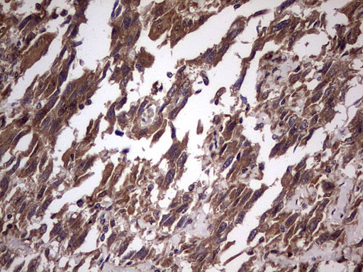 Immunohistochemical staining of paraffin-embedded Adenocarcinoma of Human ovary tissue using anti-UFD1L mouse monoclonal antibody