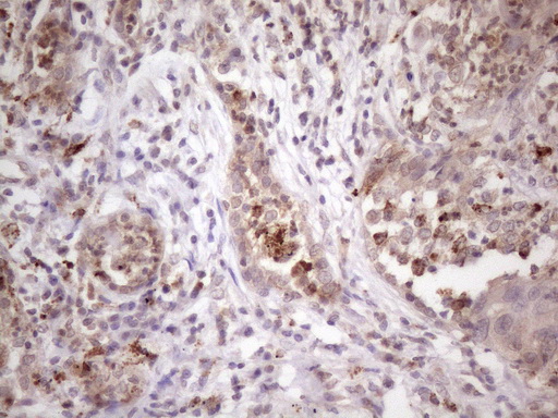 Immunohistochemical staining of paraffin-embedded Carcinoma of Human lung tissue using anti-C1orf106 mouse monoclonal antibody