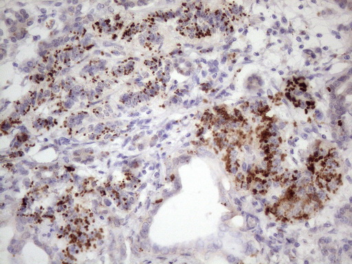Immunohistochemical staining of paraffin-embedded Carcinoma of Human pancreas tissue using anti-C1orf106 mouse monoclonal antibody