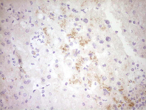 Immunohistochemical staining of paraffin-embedded Human liver tissue within the normal limits using anti-CTGF mouse monoclonal antibody