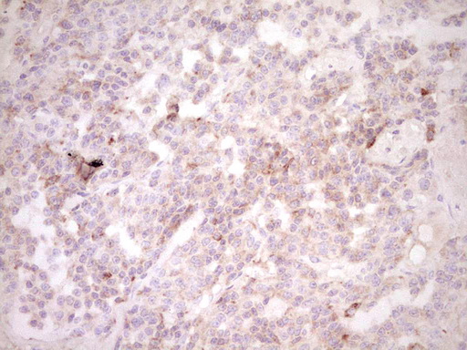 Immunohistochemical staining of paraffin-embedded Carcinoma of Human lung tissue using anti-CTGF mouse monoclonal antibody