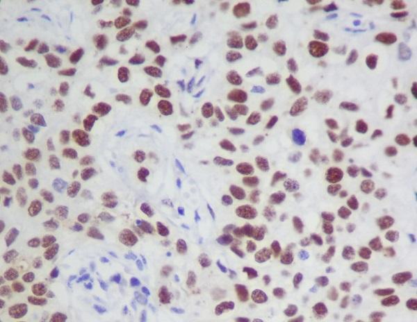 Immunohistochemical analysis of paraffin-embedded human cervix cancer, using Phospho-JAK2 (Y1007 + Y1008) Antibody