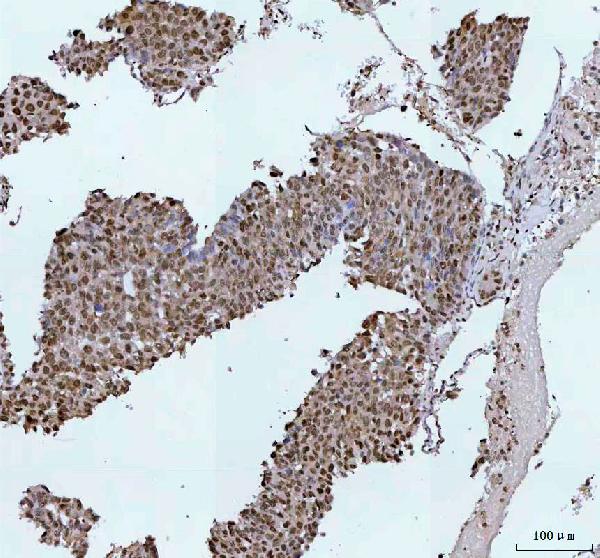 Figure 3. IHC analysis of HistoneH2A.X using anti-HistoneH2A.X antibody (MP00241). HistoneH2A.X was detected in a paraffin-embedded section of human liver cancer tissue. Heat mediated antigen retrieval was performed in EDTA buffer (pH 8.0, epitope retrieval solution). The tissue section was blocked with 10% goat serum. The tissue section was then incubated with 1:50 rabbit anti-HistoneH2A.X Antibody (MP00241) overnight at 4°C. Peroxidase Conjugated Goat Anti-rabbit IgG was used as secondary antibody and incubated for 30 minutes at 37°C. The tissue section was developed using HRP Conjugated Rabbit IgG Super Vision Assay Kit (Catalog # SV0002) with DAB as the chromogen. Figure 3. IHC analysis of HistoneH2A.X using anti-HistoneH2A.X antibody (MP00241). HistoneH2A.X was detected in a paraffin-embedded section of human liver cancer tissue. Heat mediated antigen retrieval was performed in EDTA buffer (pH 8.0, epitope retrieval solution). The tissue section was blocked with 10% goat serum. The tissue section was then incubated with 1:50 rabbit anti-HistoneH2A.X Antibody (MP00241) overnight at 4°C. Peroxidase Conjugated Goat Anti-rabbit IgG was used as secondary antibody and incubated for 30 minutes at 37°C. The tissue section was developed using HRP Conjugated Rabbit IgG Super Vision Assay Kit (Catalog # SV0002) with DAB as the chromogen.