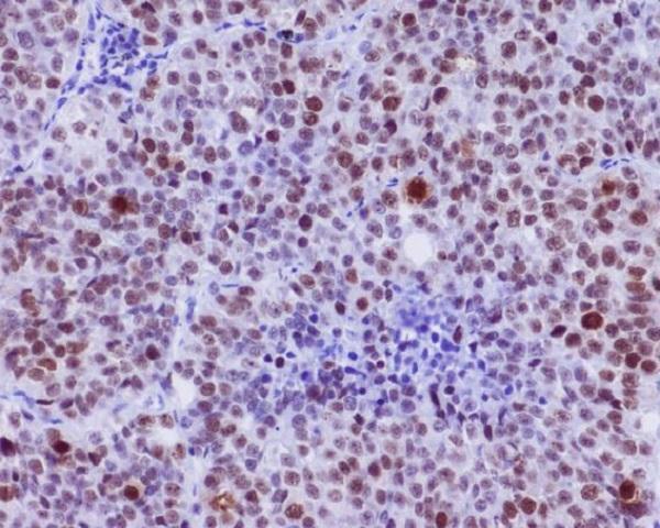 Immunohistochemical analysis of paraffin-embedded human lung carcinoma, using Phospho-c-Myc (S62) Antibody 