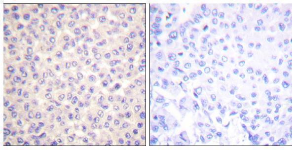 Immunohistochemistry analysis of paraffin-embedded human breast carcinoma, using FADD (Phospho-Ser194) Antibody