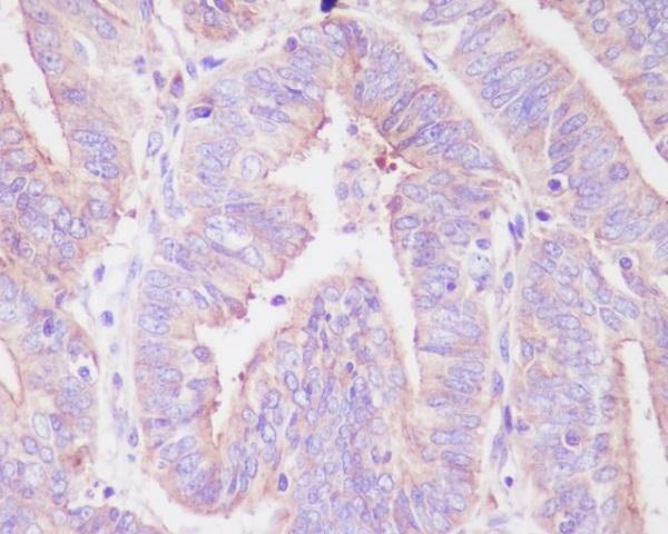 Immunohistochemical analysis of paraffin-embedded human uterus cancer, using Phospho-FoxO3a (S253) Antibody