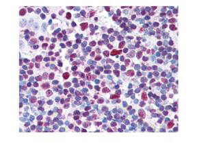 Boster's affinity purified anti-CREB pS133 antibody was used at 20µg/ml to detect signal in a variety of tissues including multi-human, multi-brain and multi-cancer slides