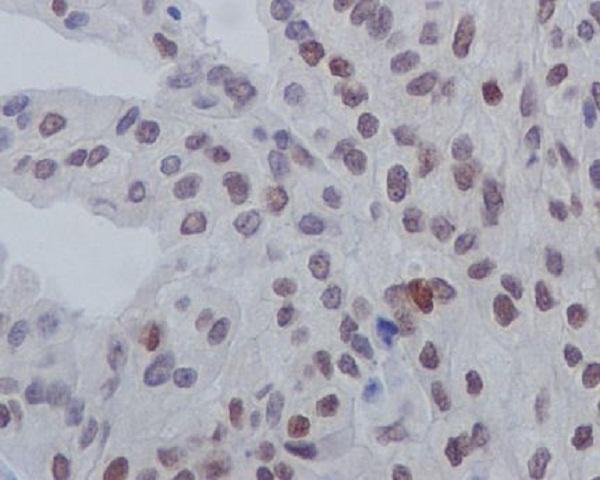 Immunohistochemical analysis of paraffin-embedded human bladder cancer, using Phospho-GATA3 (S308) Antibody