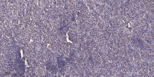 Immunohistochemical analysis of paraffin-embedded human Colon cancer