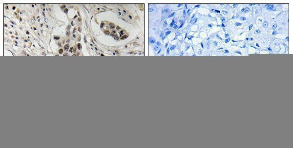 Immunohistochemistry analysis of paraffin-embedded human breast carcinoma, using NCoA2 (Phospho-Ser736) Antibody