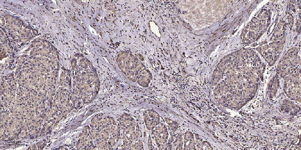 Immunohistochemical analysis of paraffin-embedded human liver cancer