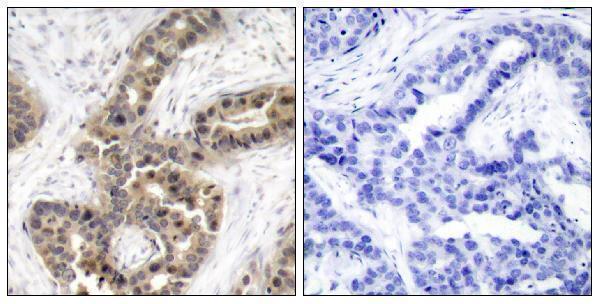 Immunohistochemistry analysis of paraffin-embedded human breast cancer, using G3BP-1 (Phospho-Ser232) Antibody