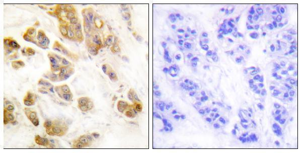 Immunohistochemistry analysis of paraffin-embedded human breast carcinoma, using CaMK1-alpha (Phospho-Thr177) Antibody