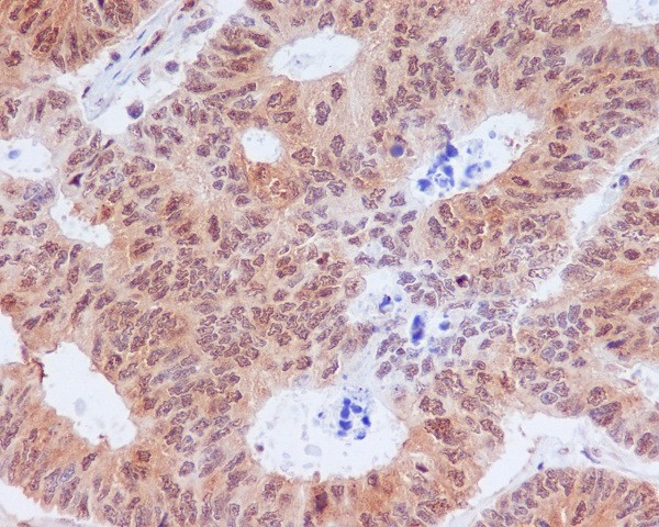 Immunohistochemical analysis of paraffin-embedded human colon cancer, using Phospho-eIF2 alpha (Ser51) Antibody. Immunohistochemical analysis of paraffin-embedded human colon cancer, using Phospho-eIF2 alpha (Ser51) Antibody.