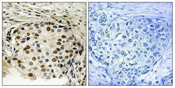 Immunohistochemistry analysis of paraffin-embedded human breast carcinoma, using OSR1 (Phospho-Thr185) Antibody