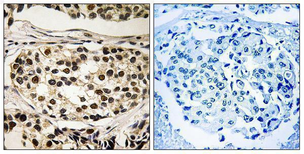 Immunohistochemistry analysis of paraffin-embedded human breast carcinoma, using Cyclin C (Phospho-Ser275) Antibody