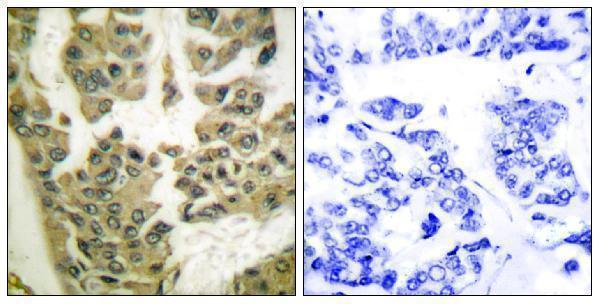 Immunohistochemistry analysis of paraffin-embedded human breast carcinoma, using GRF-1 (Phospho-Tyr1105) Antibody