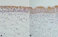 ( A ) Control ( B ) Antrochoanal polyp (ACP) patient