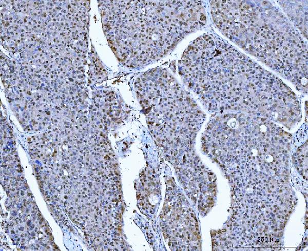 Figure 3. IHC analysis of ACLY using anti-ACLY antibody (PB10024). ACLY was detected in a paraffin-embedded section of human hepatocellular carcinoma tissue. Heat mediated antigen retrieval was performed in EDTA buffer (pH 8.0, epitope retrieval solution). The tissue section was blocked with 10% goat serum. The tissue section was then incubated with 2 microg/ml rabbit anti-ACLY Antibody (PB10024) overnight at 4°C. Peroxidase Conjugated Goat Anti-rabbit IgG was used as secondary antibody and incubated for 30 minutes at 37°C. The tissue section was developed using HRP Conjugated Rabbit IgG Super Vision Assay Kit (Catalog # SV0002) with DAB as the chromogen.