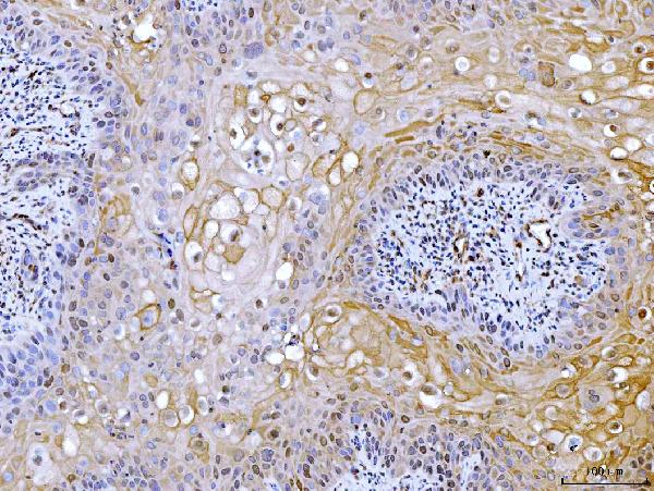 Figure 4. IHC analysis of ACLY using anti-ACLY antibody (PB10024). ACLY was detected in a paraffin-embedded section of human laryngeal squamous cell carcinoma tissue. Heat mediated antigen retrieval was performed in EDTA buffer (pH 8.0, epitope retrieval solution). The tissue section was blocked with 10% goat serum. The tissue section was then incubated with 2 microg/ml rabbit anti-ACLY Antibody (PB10024) overnight at 4°C. Peroxidase Conjugated Goat Anti-rabbit IgG was used as secondary antibody and incubated for 30 minutes at 37°C. The tissue section was developed using HRP Conjugated Rabbit IgG Super Vision Assay Kit (Catalog # SV0002) with DAB as the chromogen.