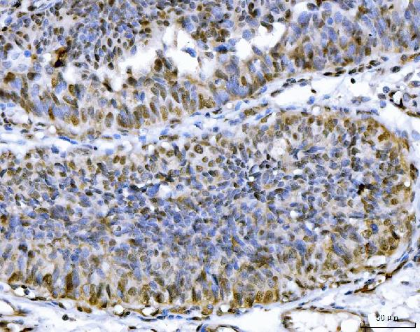 Figure 6. IHC analysis of ACLY using anti-ACLY antibody (PB10024). ACLY was detected in a paraffin-embedded section of human colon cancer tissue. Heat mediated antigen retrieval was performed in EDTA buffer (pH 8.0, epitope retrieval solution). The tissue section was blocked with 10% goat serum. The tissue section was then incubated with 2 microg/ml rabbit anti-ACLY Antibody (PB10024) overnight at 4°C. Peroxidase Conjugated Goat Anti-rabbit IgG was used as secondary antibody and incubated for 30 minutes at 37°C. The tissue section was developed using HRP Conjugated Rabbit IgG Super Vision Assay Kit (Catalog # SV0002) with DAB as the chromogen.