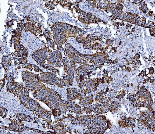Figure 3. IHC analysis of ALDH1B1 using anti-ALDH1B1 antibody (PB10037). ALDH1B1 was detected in a paraffin-embedded section of human colon cancer tissue. Heat mediated antigen retrieval was performed in EDTA buffer (pH 8.0, epitope retrieval solution). The tissue section was blocked with 10% goat serum. The tissue section was then incubated with 2 microg/ml rabbit anti-ALDH1B1 Antibody (PB10037) overnight at 4°C. Peroxidase Conjugated Goat Anti-rabbit IgG was used as secondary antibody and incubated for 30 minutes at 37°C. The tissue section was developed using HRP Conjugated Rabbit IgG Super Vision Assay Kit (Catalog # SV0002) with DAB as the chromogen.