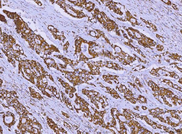 Figure 4. IHC analysis of ALDH1B1 using anti-ALDH1B1 antibody (PB10037). ALDH1B1 was detected in a paraffin-embedded section of human colonic adenocarcinoma tissue. Heat mediated antigen retrieval was performed in EDTA buffer (pH 8.0, epitope retrieval solution). The tissue section was blocked with 10% goat serum. The tissue section was then incubated with 2 microg/ml rabbit anti-ALDH1B1 Antibody (PB10037) overnight at 4°C. Peroxidase Conjugated Goat Anti-rabbit IgG was used as secondary antibody and incubated for 30 minutes at 37°C. The tissue section was developed using HRP Conjugated Rabbit IgG Super Vision Assay Kit (Catalog # SV0002) with DAB as the chromogen.