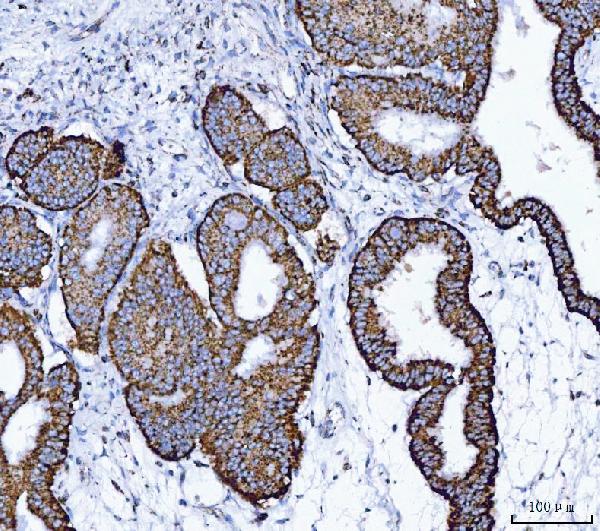 Figure 5. IHC analysis of ALDH1B1 using anti-ALDH1B1 antibody (PB10037). ALDH1B1 was detected in a paraffin-embedded section of human endometrial adenocarcinoma tissue. Heat mediated antigen retrieval was performed in EDTA buffer (pH 8.0, epitope retrieval solution). The tissue section was blocked with 10% goat serum. The tissue section was then incubated with 2 microg/ml rabbit anti-ALDH1B1 Antibody (PB10037) overnight at 4°C. Peroxidase Conjugated Goat Anti-rabbit IgG was used as secondary antibody and incubated for 30 minutes at 37°C. The tissue section was developed using HRP Conjugated Rabbit IgG Super Vision Assay Kit (Catalog # SV0002) with DAB as the chromogen.