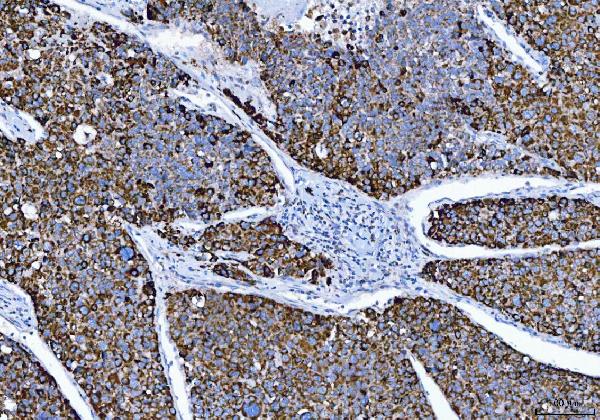 Figure 6. IHC analysis of ALDH1B1 using anti-ALDH1B1 antibody (PB10037). ALDH1B1 was detected in a paraffin-embedded section of human hepatocellular carcinoma tissue. Heat mediated antigen retrieval was performed in EDTA buffer (pH 8.0, epitope retrieval solution). The tissue section was blocked with 10% goat serum. The tissue section was then incubated with 2 microg/ml rabbit anti-ALDH1B1 Antibody (PB10037) overnight at 4°C. Peroxidase Conjugated Goat Anti-rabbit IgG was used as secondary antibody and incubated for 30 minutes at 37°C. The tissue section was developed using HRP Conjugated Rabbit IgG Super Vision Assay Kit (Catalog # SV0002) with DAB as the chromogen.