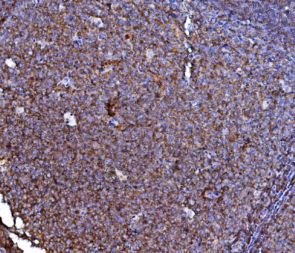 Figure 2. IHC analysis of CD40/TNFRSF5 using anti-CD40/TNFRSF5 antibody (PB10051). CD40/TNFRSF5 was detected in a paraffin-embedded section of human tonsil tissue. Heat mediated antigen retrieval was performed in EDTA buffer (pH 8.0, epitope retrieval solution). The tissue section was blocked with 10% goat serum. The tissue section was then incubated with 2 microg/ml rabbit anti-CD40/TNFRSF5 Antibody (PB10051) overnight at 4°C. Peroxidase Conjugated Goat Anti-rabbit IgG was used as secondary antibody and incubated for 30 minutes at 37°C. The tissue section was developed using HRP Conjugated Rabbit IgG Super Vision Assay Kit (Catalog # SV0002) with DAB as the chromogen. Figure 2. IHC analysis of CD40/TNFRSF5 using anti-CD40/TNFRSF5 antibody (PB10051). CD40/TNFRSF5 was detected in a paraffin-embedded section of human tonsil tissue. Heat mediated antigen retrieval was performed in EDTA buffer (pH 8.0, epitope retrieval solution). The tissue section was blocked with 10% goat serum. The tissue section was then incubated with 2 microg/ml rabbit anti-CD40/TNFRSF5 Antibody (PB10051) overnight at 4°C. Peroxidase Conjugated Goat Anti-rabbit IgG was used as secondary antibody and incubated for 30 minutes at 37°C. The tissue section was developed using HRP Conjugated Rabbit IgG Super Vision Assay Kit (Catalog # SV0002) with DAB as the chromogen.