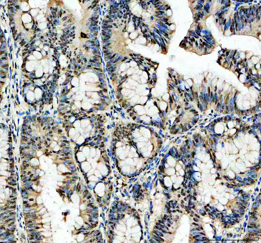 IHC analysis of TP53 using anti-TP53 antibody