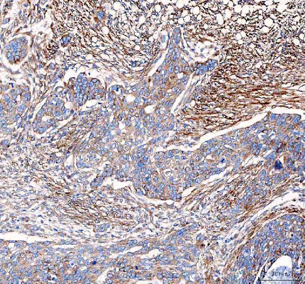 pb9071 vegfa primary antibodies ihc testing 1 IHC analysis of VEGF/VEGFA using anti-VEGF/VEGFA antibody (PB9071). 
VEGF/VEGFA was detected in a paraffin-embedded section of human ovarian serous adenocarcinoma tissue. Heat mediated antigen retrieval was performed in EDTA buffer (pH 8.0, epitope retrieval solution). The tissue section was blocked with 10% goat serum. The tissue section was then incubated with 2 μg/ml rabbit anti-VEGF/VEGFA Antibody (PB9071) overnight at 4°C. Peroxidase Conjugated Goat Anti-rabbit IgG was used as secondary antibody and incubated for 30 minutes at 37°C. The tissue section was developed using HRP Conjugated Rabbit IgG Super Vision Assay Kit (Catalog # SV0002) with DAB as the chromogen.