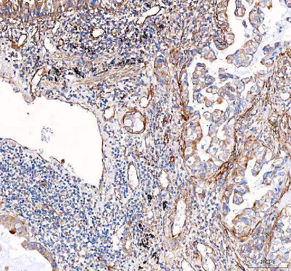 pb9071 vegfa primary antibodies ihc testing 2 IHC analysis of VEGF/VEGFA using anti-VEGF/VEGFA antibody (PB9071). 
VEGF/VEGFA was detected in a paraffin-embedded section of human lung cancer tissue. Heat mediated antigen retrieval was performed in EDTA buffer (pH 8.0, epitope retrieval solution). The tissue section was blocked with 10% goat serum. The tissue section was then incubated with 2 μg/ml rabbit anti-VEGF/VEGFA Antibody (PB9071) overnight at 4°C. Peroxidase Conjugated Goat Anti-rabbit IgG was used as secondary antibody and incubated for 30 minutes at 37°C. The tissue section was developed using HRP Conjugated Rabbit IgG Super Vision Assay Kit (Catalog # SV0002) with DAB as the chromogen.