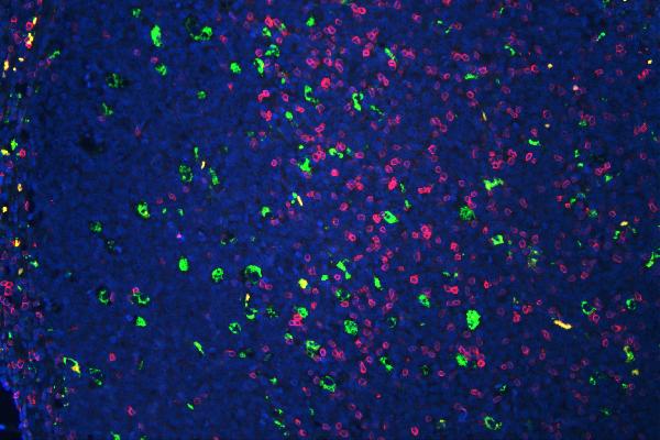 Figure 7. IF analysis of CD3E and CD68 using anti-CD3E antibody (PB9093) and anti-CD68 antibody (M00602) CD3E and CD68 was detected in paraffin-embedded section of human tonsil tissues. Heat mediated antigen retrieval was performed in citrate buffer (pH6, epitope retrieval solution ) for 20 mins. The tissue section was blocked with 10% goat serum. The tissue section was then incubated with 1microg/mL rabbit anti-CD3E Antibody (PB9093) and mouse anti CD68 Antibody(M00602) overnight at 4°C. DyLight®488 Conjugated Goat Anti-Mouse IgG (BA1126) and Biotin conjugated goat anti-rabbit IgG (BA1003) were used as secondary antibody at 1:100 dilution and incubated for 30 minutes at 37°C. The tissue section was developed using Cy3 Conjugated Avidin (BA1037). The section was counterstained with DAPI. Visualize using a fluorescence microscope and filter sets appropriate for the label used. Figure 7. IF analysis of CD3E and CD68 using anti-CD3E antibody (PB9093) and anti-CD68 antibody (M00602) CD3E and CD68 was detected in paraffin-embedded section of human tonsil tissues. Heat mediated antigen retrieval was performed in citrate buffer (pH6, epitope retrieval solution ) for 20 mins. The tissue section was blocked with 10% goat serum. The tissue section was then incubated with 1microg/mL rabbit anti-CD3E Antibody (PB9093) and mouse anti CD68 Antibody(M00602) overnight at 4°C. DyLight®488 Conjugated Goat Anti-Mouse IgG (BA1126) and Biotin conjugated goat anti-rabbit IgG (BA1003) were used as secondary antibody at 1:100 dilution and incubated for 30 minutes at 37°C. The tissue section was developed using Cy3 Conjugated Avidin (BA1037). The section was counterstained with DAPI. Visualize using a fluorescence microscope and filter sets appropriate for the label used.