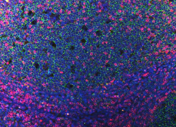 Figure 8. IF analysis of CD3E and CD20 using anti-CD3E antibody (PB9093) and anti-CD20 antibody (M03780-5). CD3E and CD20 was detected in a paraffin-embedded section of human tonsil tissue. Heat mediated antigen retrieval was performed in EDTA buffer (pH 8.0, epitope retrieval solution). The tissue section was blocked with 10% goat serum. The tissue section was then incubated with 2 microg/mL rabbit anti-CD3E antibody (PB9093) and mouse anti-CD20 antibody (M03780-5) overnight at 4°C. DyLight®550 Conjugated Goat Anti-Rabbit IgG (BA1135), DyLight®488 Conjugated Goat Anti-Mouse IgG (BA1126) was used as secondary antibody at 1:100 dilution and incubated for 30 minutes at 37°C. The section was counterstained with DAPI. Visualize using a fluorescence microscope and filter sets appropriate for the label used. Figure 8. IF analysis of CD3E and CD20 using anti-CD3E antibody (PB9093) and anti-CD20 antibody (M03780-5). CD3E and CD20 was detected in a paraffin-embedded section of human tonsil tissue. Heat mediated antigen retrieval was performed in EDTA buffer (pH 8.0, epitope retrieval solution). The tissue section was blocked with 10% goat serum. The tissue section was then incubated with 2 microg/mL rabbit anti-CD3E antibody (PB9093) and mouse anti-CD20 antibody (M03780-5) overnight at 4°C. DyLight®550 Conjugated Goat Anti-Rabbit IgG (BA1135), DyLight®488 Conjugated Goat Anti-Mouse IgG (BA1126) was used as secondary antibody at 1:100 dilution and incubated for 30 minutes at 37°C. The section was counterstained with DAPI. Visualize using a fluorescence microscope and filter sets appropriate for the label used.