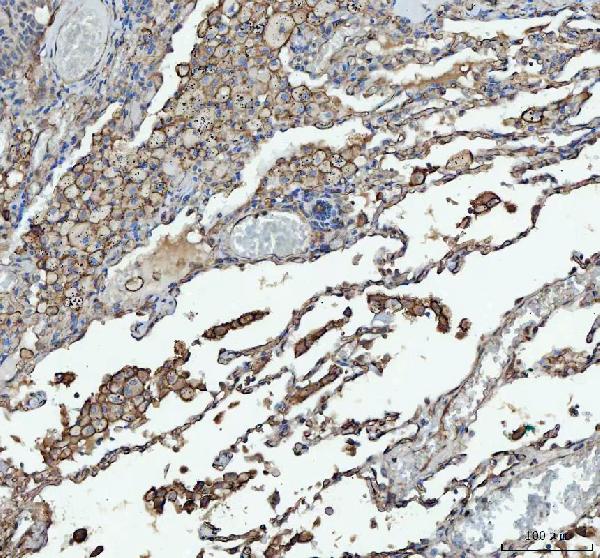 Figure 2. IHC analysis of ACE using anti-ACE antibody (PB9124). ACE was detected in paraffin-embedded section of human lung cancer tissue. Heat mediated antigen retrieval was performed in citrate buffer (pH6, epitope retrieval solution) for 20 mins. The tissue section was blocked with 10% goat serum. The tissue section was then incubated with 1microg/ml rabbit anti-ACE Antibody (PB9124) overnight at 4°C. Biotinylated goat anti-rabbit IgG was used as secondary antibody and incubated for 30 minutes at 37°C. The tissue section was developed using Strepavidin-Biotin-Complex (SABC)(Catalog # SA1022) with DAB as the chromogen. Figure 2. IHC analysis of ACE using anti-ACE antibody (PB9124). ACE was detected in paraffin-embedded section of human lung cancer tissue. Heat mediated antigen retrieval was performed in citrate buffer (pH6, epitope retrieval solution) for 20 mins. The tissue section was blocked with 10% goat serum. The tissue section was then incubated with 1microg/ml rabbit anti-ACE Antibody (PB9124) overnight at 4°C. Biotinylated goat anti-rabbit IgG was used as secondary antibody and incubated for 30 minutes at 37°C. The tissue section was developed using Strepavidin-Biotin-Complex (SABC)(Catalog # SA1022) with DAB as the chromogen.
