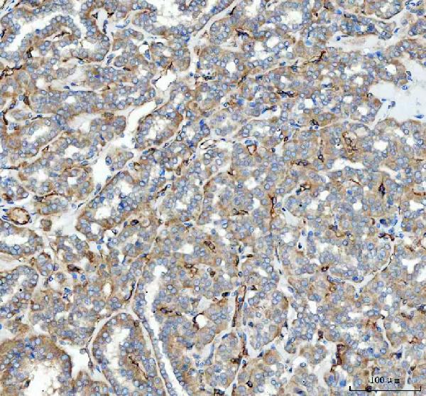 Figure 3. IHC analysis of ACE using anti-ACE antibody (PB9124). ACE was detected in paraffin-embedded section of human thyroid cancer tissue. Heat mediated antigen retrieval was performed in citrate buffer (pH6, epitope retrieval solution) for 20 mins. The tissue section was blocked with 10% goat serum. The tissue section was then incubated with 1microg/ml rabbit anti-ACE Antibody (PB9124) overnight at 4°C. Biotinylated goat anti-rabbit IgG was used as secondary antibody and incubated for 30 minutes at 37°C. The tissue section was developed using Strepavidin-Biotin-Complex (SABC)(Catalog # SA1022) with DAB as the chromogen. Figure 3. IHC analysis of ACE using anti-ACE antibody (PB9124). ACE was detected in paraffin-embedded section of human thyroid cancer tissue. Heat mediated antigen retrieval was performed in citrate buffer (pH6, epitope retrieval solution) for 20 mins. The tissue section was blocked with 10% goat serum. The tissue section was then incubated with 1microg/ml rabbit anti-ACE Antibody (PB9124) overnight at 4°C. Biotinylated goat anti-rabbit IgG was used as secondary antibody and incubated for 30 minutes at 37°C. The tissue section was developed using Strepavidin-Biotin-Complex (SABC)(Catalog # SA1022) with DAB as the chromogen.