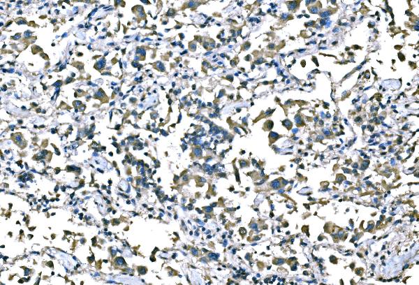 Figure 3. IHC analysis of B Raf/BRAF using anti-B Raf/BRAF antibody (PB9164). B Raf/BRAF was detected in a paraffin-embedded section of human lung cancer tissue. Heat mediated antigen retrieval was performed in EDTA buffer (pH 8.0, epitope retrieval solution). The tissue section was blocked with 10% goat serum. The tissue section was then incubated with 2 microg/ml rabbit anti-B Raf/BRAF Antibody (PB9164) overnight at 4°C. Peroxidase Conjugated Goat Anti-rabbit IgG was used as secondary antibody and incubated for 30 minutes at 37°C. The tissue section was developed using HRP Conjugated Rabbit IgG Super Vision Assay Kit (Catalog # SV0002) with DAB as the chromogen. Figure 3. IHC analysis of B Raf/BRAF using anti-B Raf/BRAF antibody (PB9164). B Raf/BRAF was detected in a paraffin-embedded section of human lung cancer tissue. Heat mediated antigen retrieval was performed in EDTA buffer (pH 8.0, epitope retrieval solution). The tissue section was blocked with 10% goat serum. The tissue section was then incubated with 2 microg/ml rabbit anti-B Raf/BRAF Antibody (PB9164) overnight at 4°C. Peroxidase Conjugated Goat Anti-rabbit IgG was used as secondary antibody and incubated for 30 minutes at 37°C. The tissue section was developed using HRP Conjugated Rabbit IgG Super Vision Assay Kit (Catalog # SV0002) with DAB as the chromogen.
