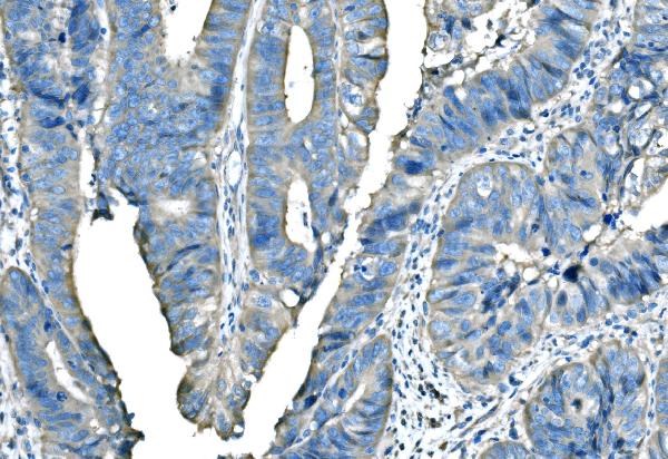 Figure 5. IHC analysis of B Raf/BRAF using anti-B Raf/BRAF antibody (PB9164). B Raf/BRAF was detected in a paraffin-embedded section of human differentiated adenocarcinoma of the rectum tissue. Heat mediated antigen retrieval was performed in EDTA buffer (pH 8.0, epitope retrieval solution). The tissue section was blocked with 10% goat serum. The tissue section was then incubated with 2 microg/ml rabbit anti-B Raf/BRAF Antibody (PB9164) overnight at 4°C. Peroxidase Conjugated Goat Anti-rabbit IgG was used as secondary antibody and incubated for 30 minutes at 37°C. The tissue section was developed using HRP Conjugated Rabbit IgG Super Vision Assay Kit (Catalog # SV0002) with DAB as the chromogen. Figure 5. IHC analysis of B Raf/BRAF using anti-B Raf/BRAF antibody (PB9164). B Raf/BRAF was detected in a paraffin-embedded section of human differentiated adenocarcinoma of the rectum tissue. Heat mediated antigen retrieval was performed in EDTA buffer (pH 8.0, epitope retrieval solution). The tissue section was blocked with 10% goat serum. The tissue section was then incubated with 2 microg/ml rabbit anti-B Raf/BRAF Antibody (PB9164) overnight at 4°C. Peroxidase Conjugated Goat Anti-rabbit IgG was used as secondary antibody and incubated for 30 minutes at 37°C. The tissue section was developed using HRP Conjugated Rabbit IgG Super Vision Assay Kit (Catalog # SV0002) with DAB as the chromogen.