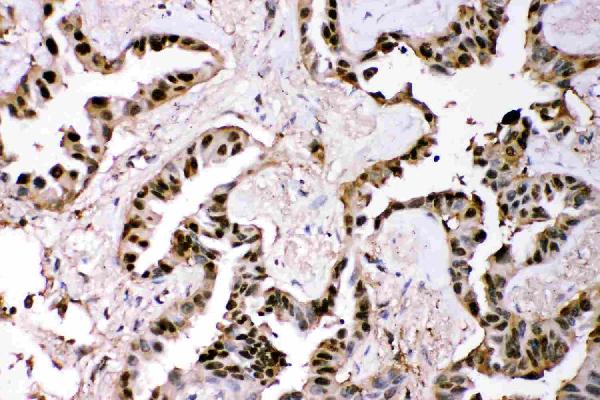 Figure 3. IHC analysis of GST3/GST pi using anti-GST3/GST pi antibody (PB9184). GST3/GST pi was detected in a paraffin-embedded section of human lung cancer tissue. Heat mediated antigen retrieval was performed in EDTA buffer (pH 8.0, epitope retrieval solution). The tissue section was blocked with 10% goat serum. The tissue section was then incubated with 1 microg/ml rabbit anti-GST3/GST pi Antibody (PB9184) overnight at 4°C. Biotinylated goat anti-rabbit IgG was used as secondary antibody and incubated for 30 minutes at 37°C. The tissue section was developed using Strepavidin-Biotin-Complex (SABC) (Catalog # SA1022) with DAB as the chromogen. Figure 3. IHC analysis of GST3/GST pi using anti-GST3/GST pi antibody (PB9184). GST3/GST pi was detected in a paraffin-embedded section of human lung cancer tissue. Heat mediated antigen retrieval was performed in EDTA buffer (pH 8.0, epitope retrieval solution). The tissue section was blocked with 10% goat serum. The tissue section was then incubated with 1 microg/ml rabbit anti-GST3/GST pi Antibody (PB9184) overnight at 4°C. Biotinylated goat anti-rabbit IgG was used as secondary antibody and incubated for 30 minutes at 37°C. The tissue section was developed using Strepavidin-Biotin-Complex (SABC) (Catalog # SA1022) with DAB as the chromogen.