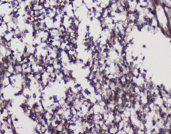 Figure 4. IHC analysis of GRIK1 using anti-GRIK1 antibody (PB9208). GRIK1 was detected in paraffin-embedded section of human glioma tissues. Heat mediated antigen retrieval was performed in citrate buffer (pH6, epitope retrieval solution) for 20 mins. The tissue section was blocked with 10% goat serum. The tissue section was then incubated with 1microg/ml rabbit anti-GRIK1 Antibody (PB9208) overnight at 4°C. Biotinylated goat anti-rabbit IgG was used as secondary antibody and incubated for 30 minutes at 37°C. The tissue section was developed using Strepavidin-Biotin-Complex (SABC)(Catalog # SA1022) with DAB as the chromogen.