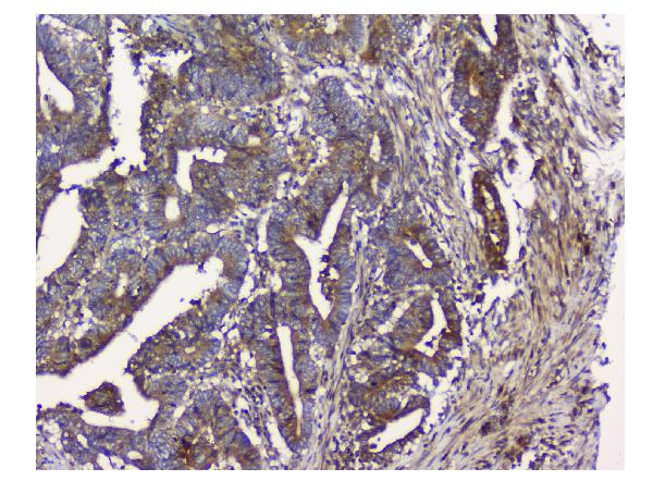 Figure 2. IHC analysis of NMI using anti-NMI antibody (PB9340). NMI was detected in paraffin-embedded section of human colon cancer tissue. Heat mediated antigen retrieval was performed in EDTA buffer (pH8.0, epitope retrieval solution). The tissue section was blocked with 10% goat serum. The tissue section was then incubated with 1microg/ml rabbit anti-NMI Antibody (PB9340) overnight at 4°C. Biotinylated goat anti-rabbit IgG was used as secondary antibody and incubated for 30 minutes at 37°C. The tissue section was developed using Strepavidin-Biotin-Complex (SABC) (Catalog # SA1022) with DAB as the chromogen.