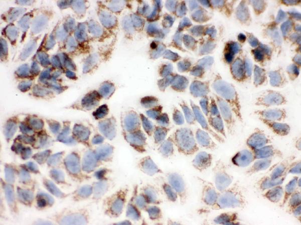 Figure 4. IHC analysis of Peroxiredoxin 3 using anti-Peroxiredoxin 3 antibody (PB9349). Peroxiredoxin 3 was detected in immunocytochemical section of MCF-7 cell. Enzyme antigen retrieval was performed using IHC enzyme antigen retrieval reagent (AR0022) for 15 mins. The cells were blocked with 10% goat serum. And then incubated with 1microg/ml rabbit anti-Peroxiredoxin 3 Antibody (PB9349) overnight at 4°C. Biotinylated goat anti-rabbit IgG was used as secondary antibody and incubated for 30 minutes at 37°C. The section was developed using Strepavidin-Biotin-Complex (SABC)(Catalog # SA1022) with DAB as the chromogen.