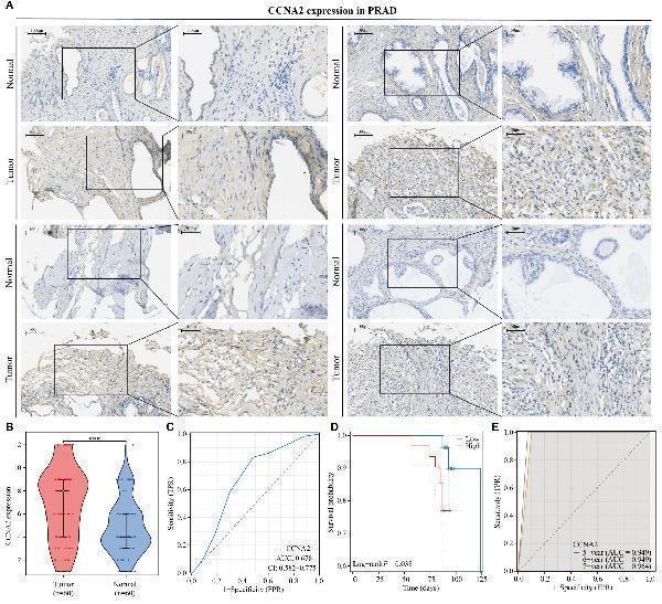 CCNA2 is highly expressed in PRAD and is associated with poor patient prognosis