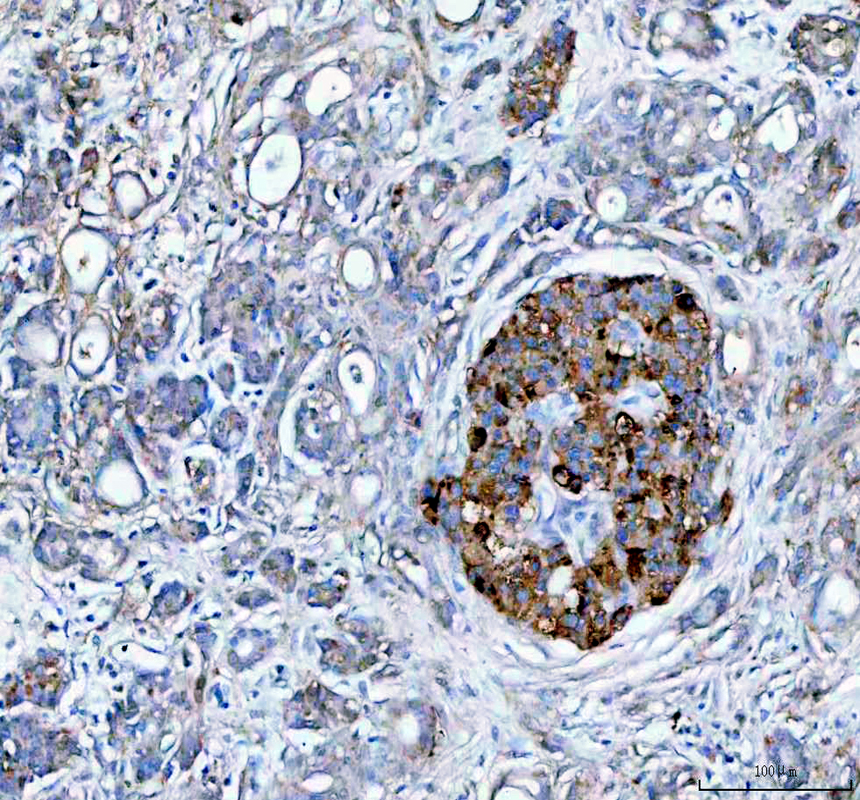 IHC analysis of IGFBP2 using anti-IGFBP2 antibody (PB9605)