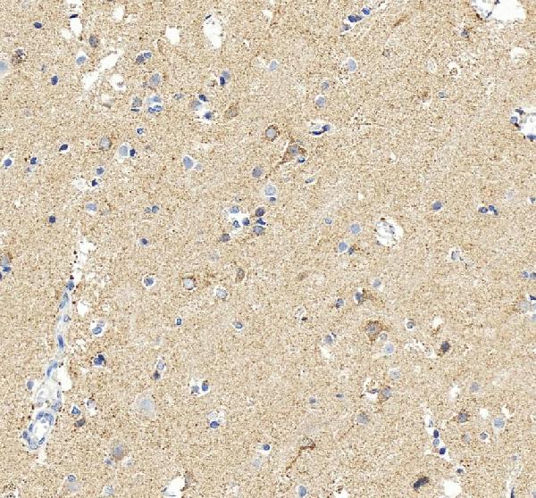 Figure 2. IHC analysis of MAOB using anti-MAOB antibody (PB9665). MAOB was detected in a paraffin-embedded section of human liver cancer tissue. Heat mediated antigen retrieval was performed in EDTA buffer (pH 8.0, epitope retrieval solution). The tissue section was blocked with 10% goat serum. The tissue section was then incubated with 2 microg/ml rabbit anti-MAOB Antibody (PB9665) overnight at 4°C. Peroxidase Conjugated Goat Anti-rabbit IgG was used as secondary antibody and incubated for 30 minutes at 37°C. The tissue section was developed using HRP Conjugated Rabbit IgG Super Vision Assay Kit (Catalog # SV0002) with DAB as the chromogen.