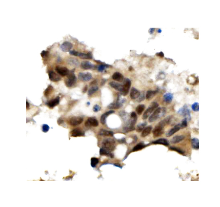 Figure 5. IHC analysis of OGT using anti-OGT antibody (PB9767). OGT was detected in paraffin-embedded section of human pancreatic cancer tissue. Heat mediated antigen retrieval was performed in EDTA buffer (pH8.0, epitope retrieval solution). The tissue section was blocked with 10% goat serum. The tissue section was then incubated with 1microg/ml rabbit anti-OGT Antibody (PB9767) overnight at 4°C. Biotinylated goat anti-rabbit IgG was used as secondary antibody and incubated for 30 minutes at 37°C. The tissue section was developed using Strepavidin-Biotin-Complex (SABC) (Catalog # SA1022) with DAB as the chromogen. Figure 5. IHC analysis of OGT using anti-OGT antibody (PB9767). OGT was detected in paraffin-embedded section of human pancreatic cancer tissue. Heat mediated antigen retrieval was performed in EDTA buffer (pH8.0, epitope retrieval solution). The tissue section was blocked with 10% goat serum. The tissue section was then incubated with 1microg/ml rabbit anti-OGT Antibody (PB9767) overnight at 4°C. Biotinylated goat anti-rabbit IgG was used as secondary antibody and incubated for 30 minutes at 37°C. The tissue section was developed using Strepavidin-Biotin-Complex (SABC) (Catalog # SA1022) with DAB as the chromogen.