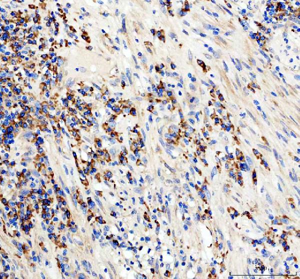 Figure 2. IHC analysis of CD19 using anti-CD19 antibody (PB9800). CD19 was detected in a paraffin-embedded section of human appendix tissue. Heat mediated antigen retrieval was performed in EDTA buffer (pH 8.0, epitope retrieval solution). The tissue section was blocked with 10% goat serum. The tissue section was then incubated with 2 microg/ml rabbit anti-CD19 Antibody (PB9800) overnight at 4°C. Peroxidase Conjugated Goat Anti-rabbit IgG was used as secondary antibody and incubated for 30 minutes at 37°C. The tissue section was developed using HRP Conjugated Rabbit IgG Super Vision Assay Kit (Catalog # SV0002) with DAB as the chromogen. Figure 2. IHC analysis of CD19 using anti-CD19 antibody (PB9800). CD19 was detected in a paraffin-embedded section of human appendix tissue. Heat mediated antigen retrieval was performed in EDTA buffer (pH 8.0, epitope retrieval solution). The tissue section was blocked with 10% goat serum. The tissue section was then incubated with 2 microg/ml rabbit anti-CD19 Antibody (PB9800) overnight at 4°C. Peroxidase Conjugated Goat Anti-rabbit IgG was used as secondary antibody and incubated for 30 minutes at 37°C. The tissue section was developed using HRP Conjugated Rabbit IgG Super Vision Assay Kit (Catalog # SV0002) with DAB as the chromogen.